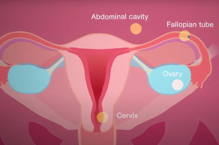 Ectopic Pregnancy